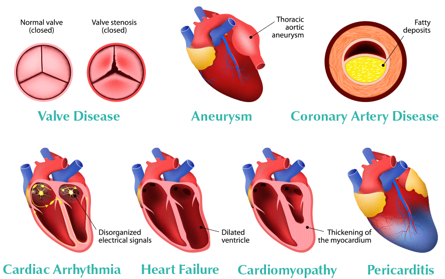 Types of Heart Disease