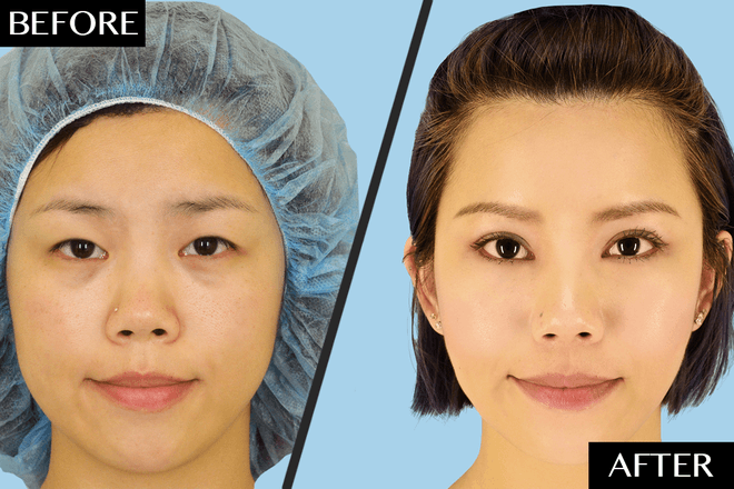 Blepharoplasty, Before and After