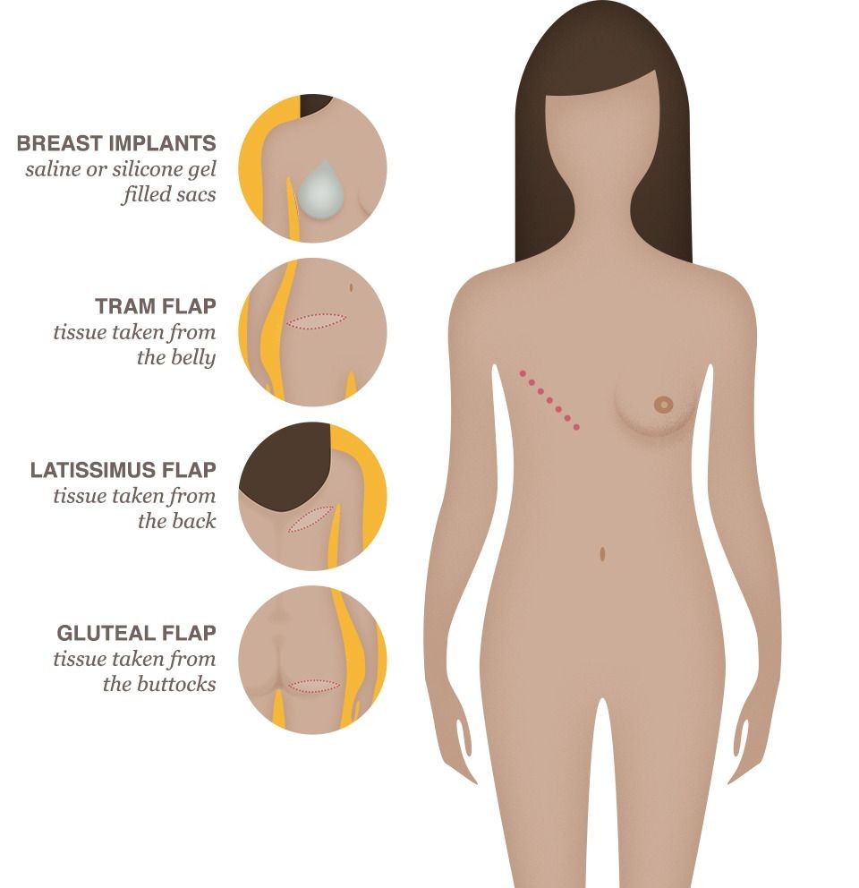 Breast Reconstruction Options