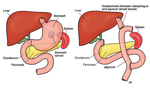 Cancer of the middle and upper parts of the stomach