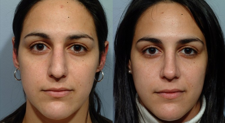 Septoplasty Before and After
