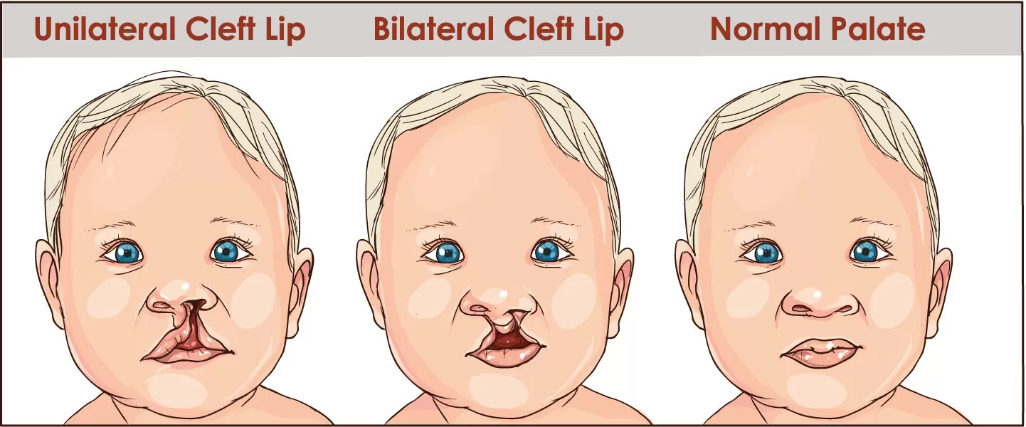 Cleft Lip or Palate Repair
