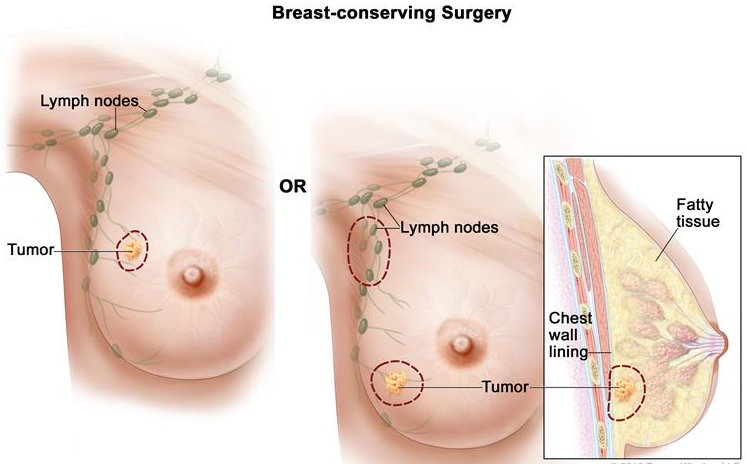 Breast Conserving Surgery