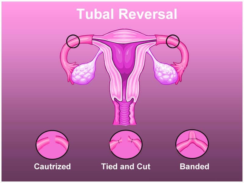 Types of Tubal Ligation