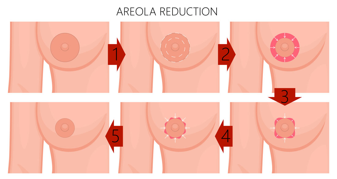 Areola Reduction