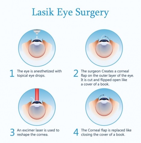 LASIK in Singapore