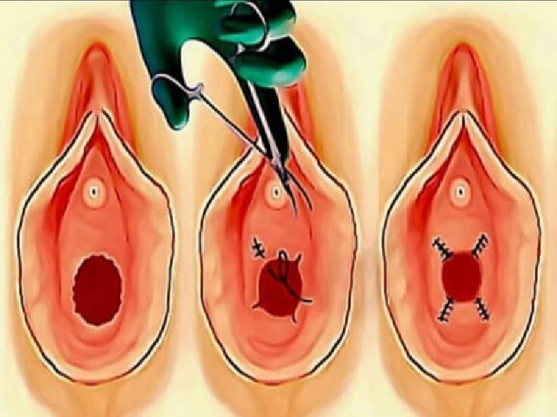 Hymenoplasty Procedure