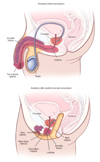 Process Of Sex Change Female To Male